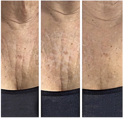 neck before and after