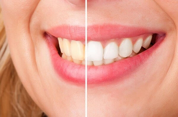Before and after smile