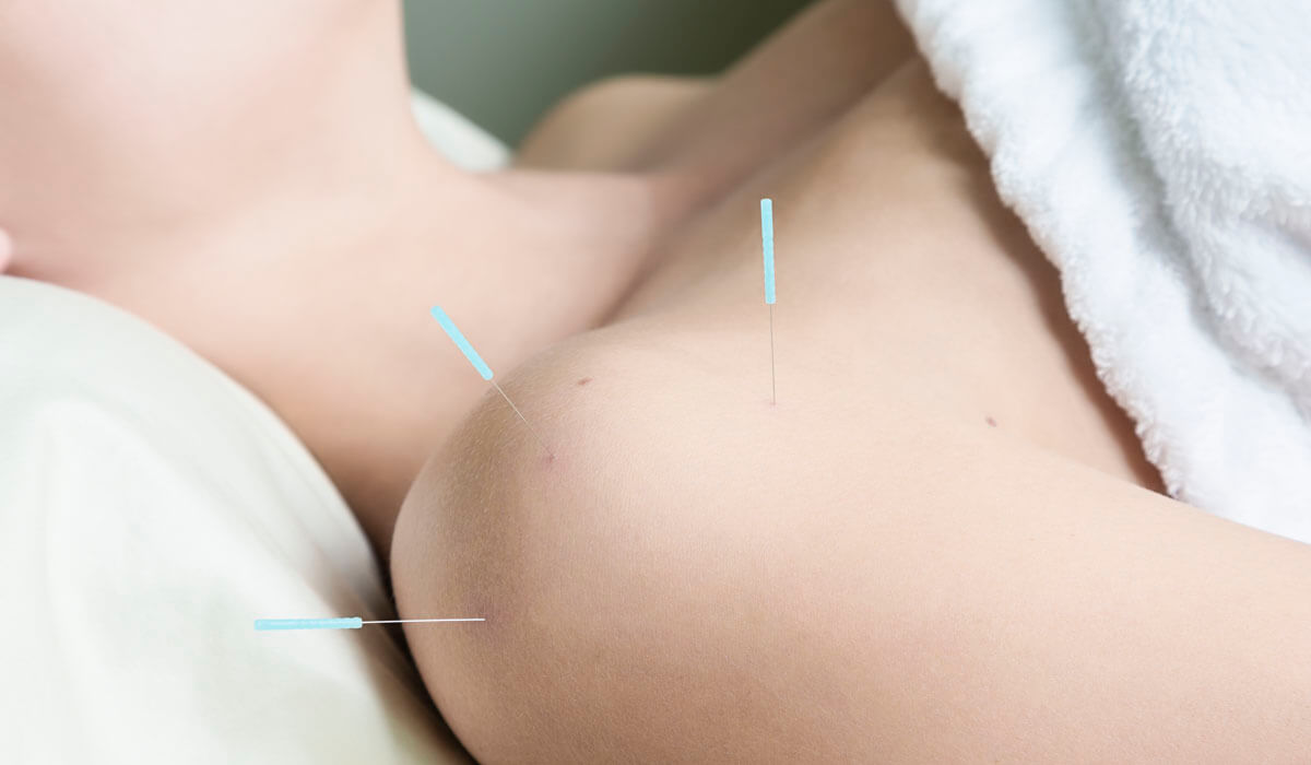 Acupuncture patient