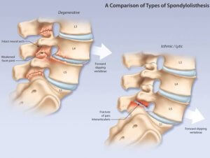 Spondylolisthesis forward translation