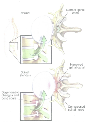 Spinal Stenosis Image