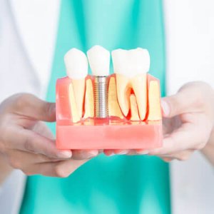 dentist holding implants model