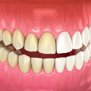 full-mouth-whitening-example-sq