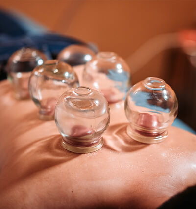 cupping theraphy