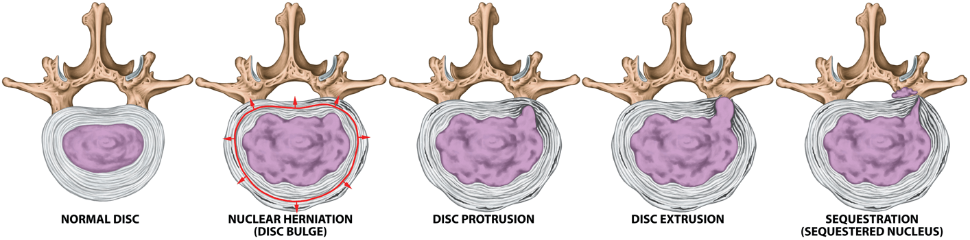 spinal-disc-herniation-stages