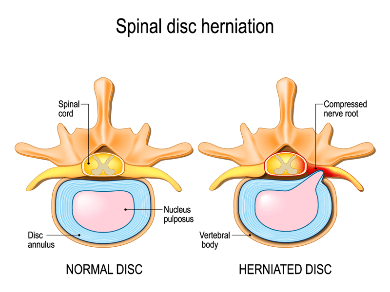 spinal-disc-herniation