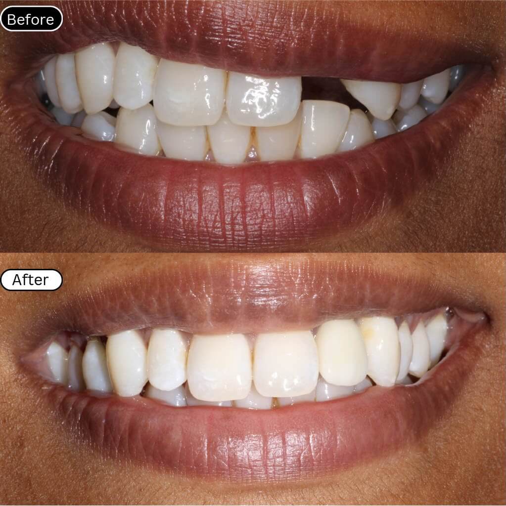 Implant 1