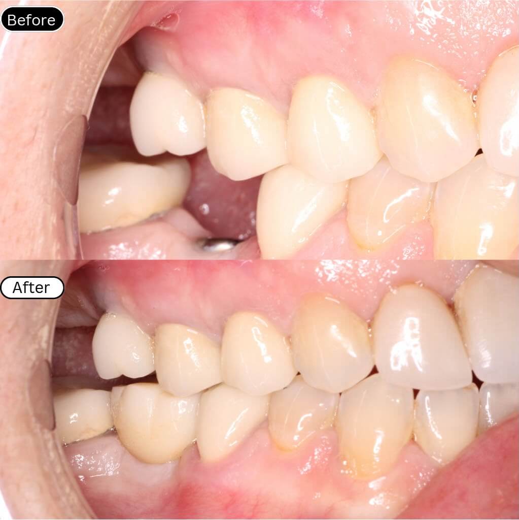 Implant 2