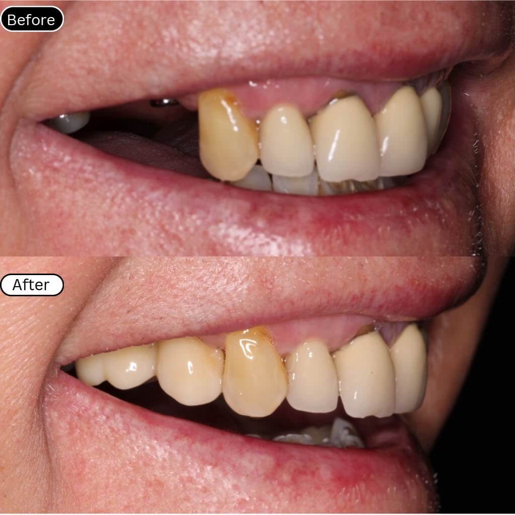 Implant 3