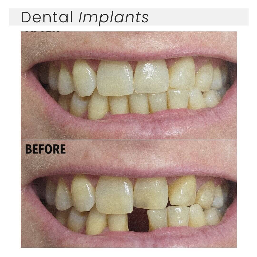 Dental implants
