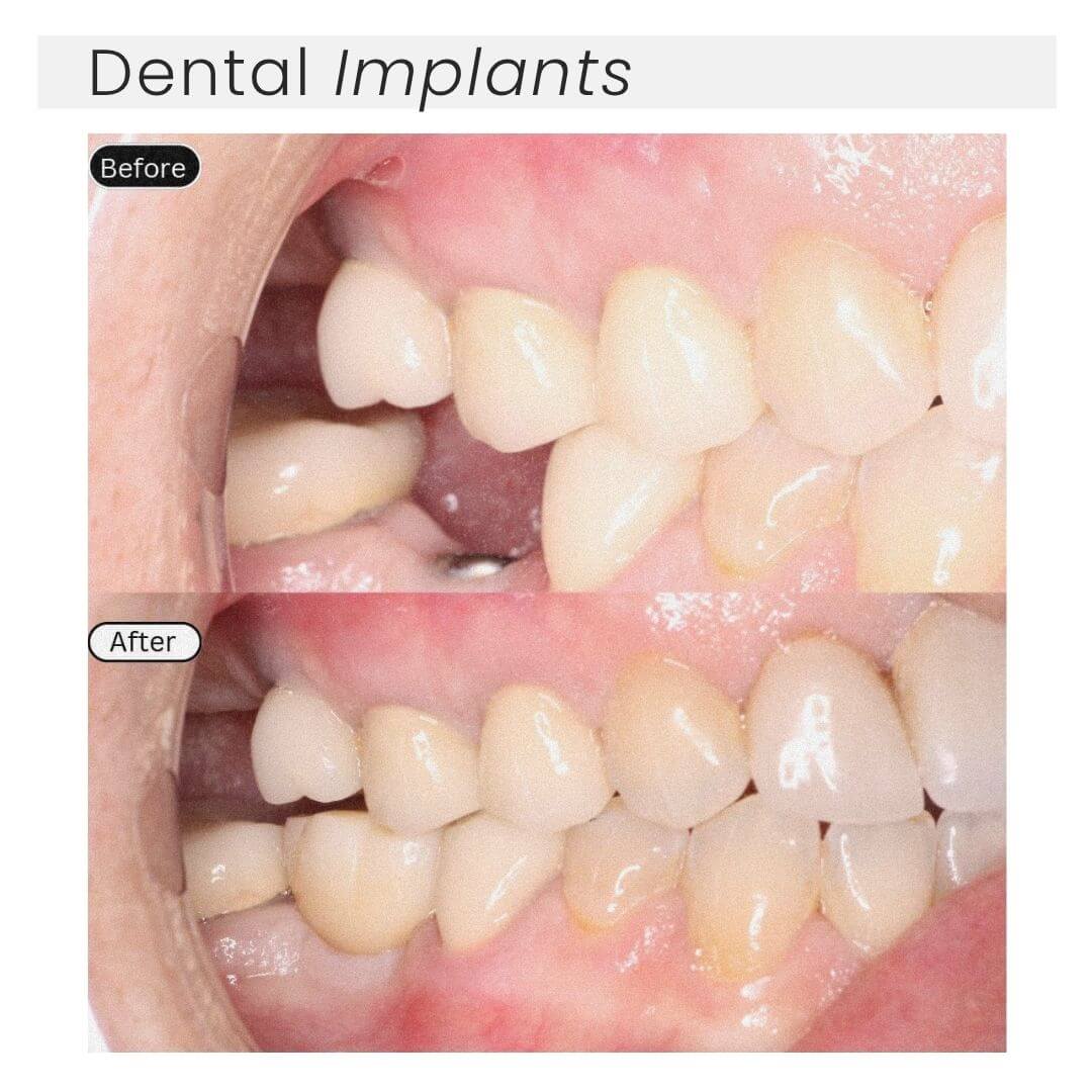 Dental implants
