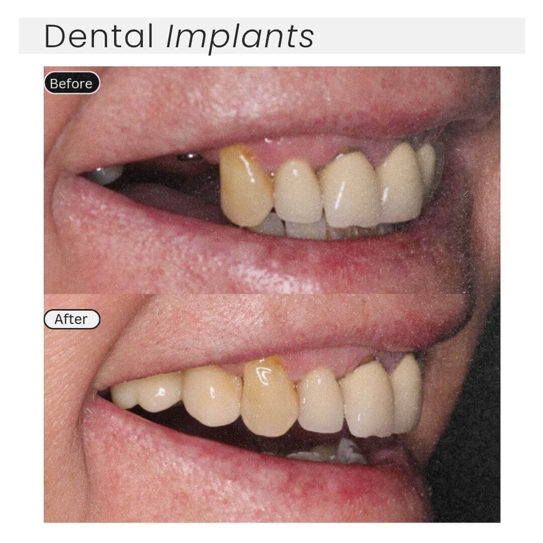 Dental implants