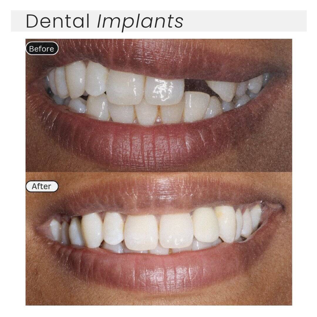 Dental implants