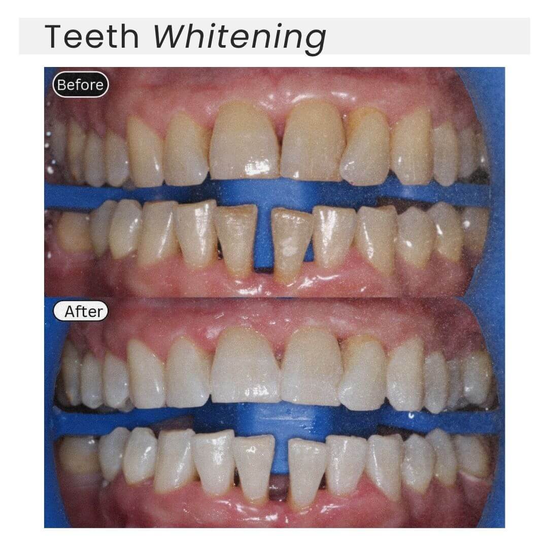 teeth whitening