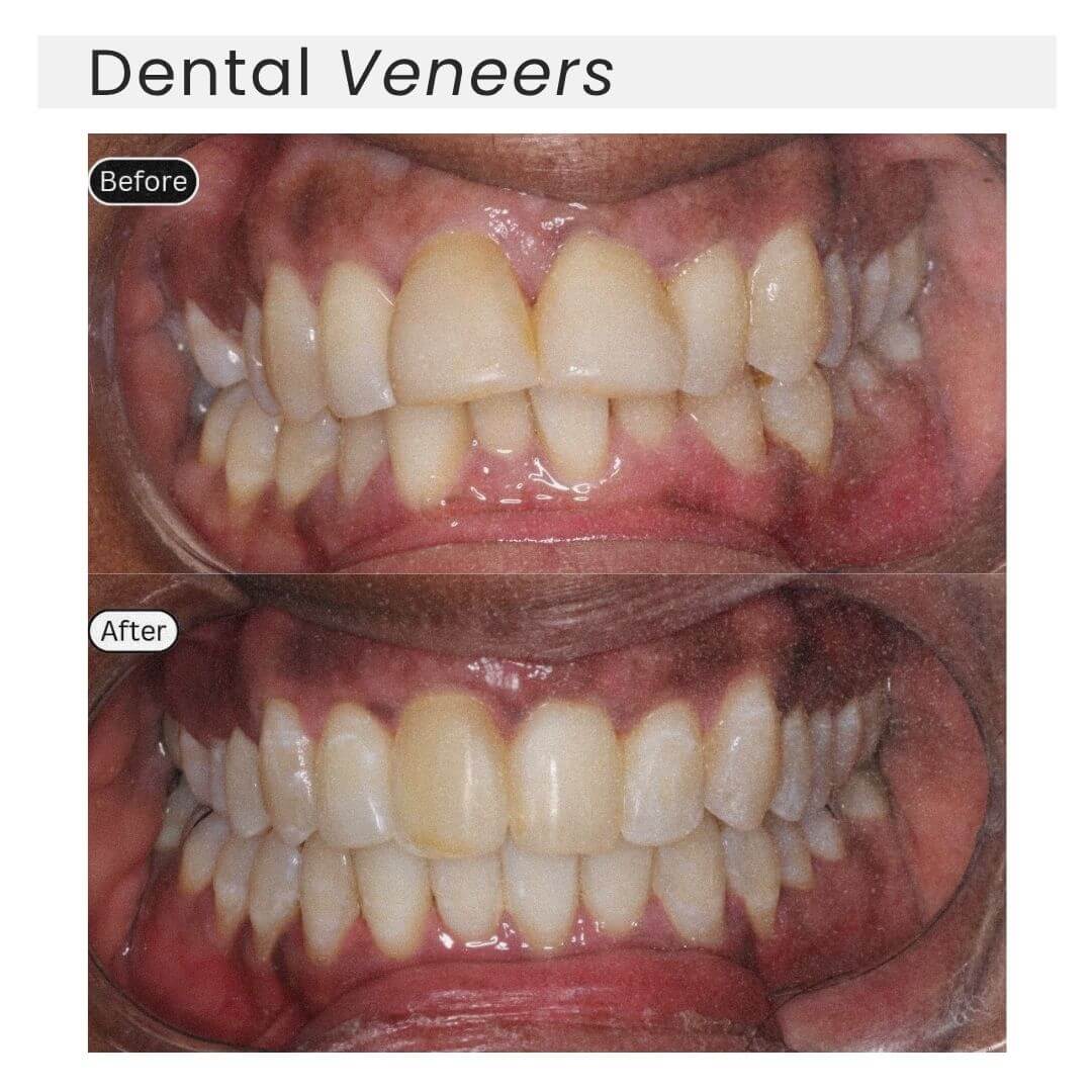 dental veneers