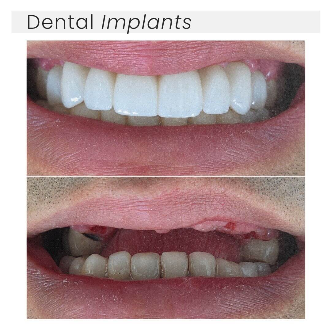 Dental implants