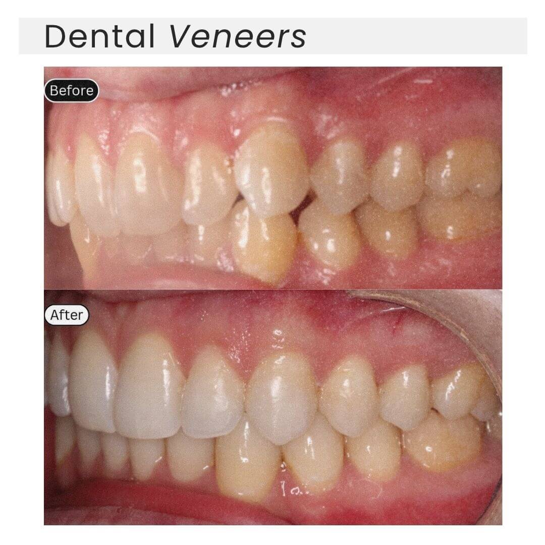 dental veneers