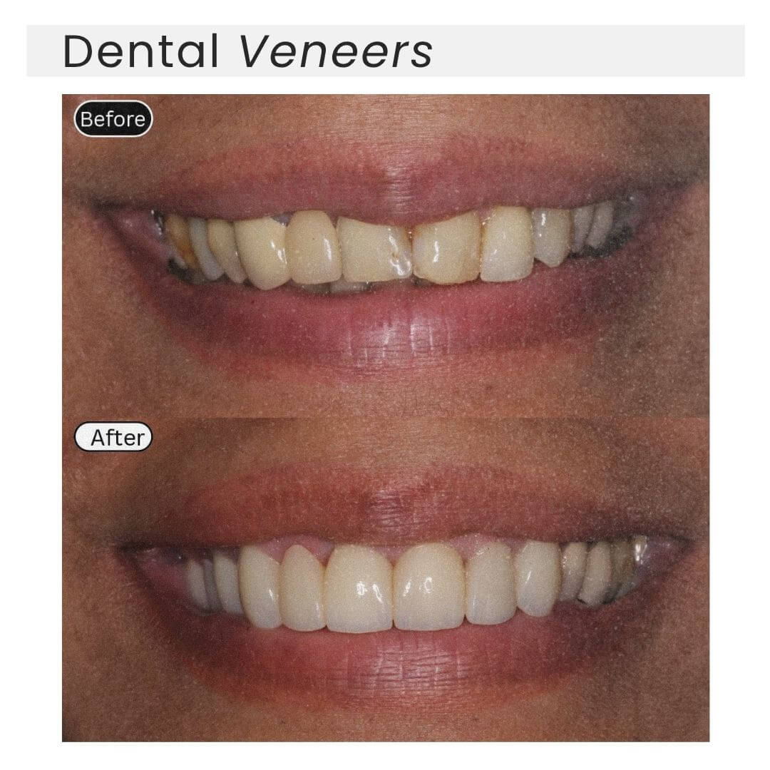dental veneers