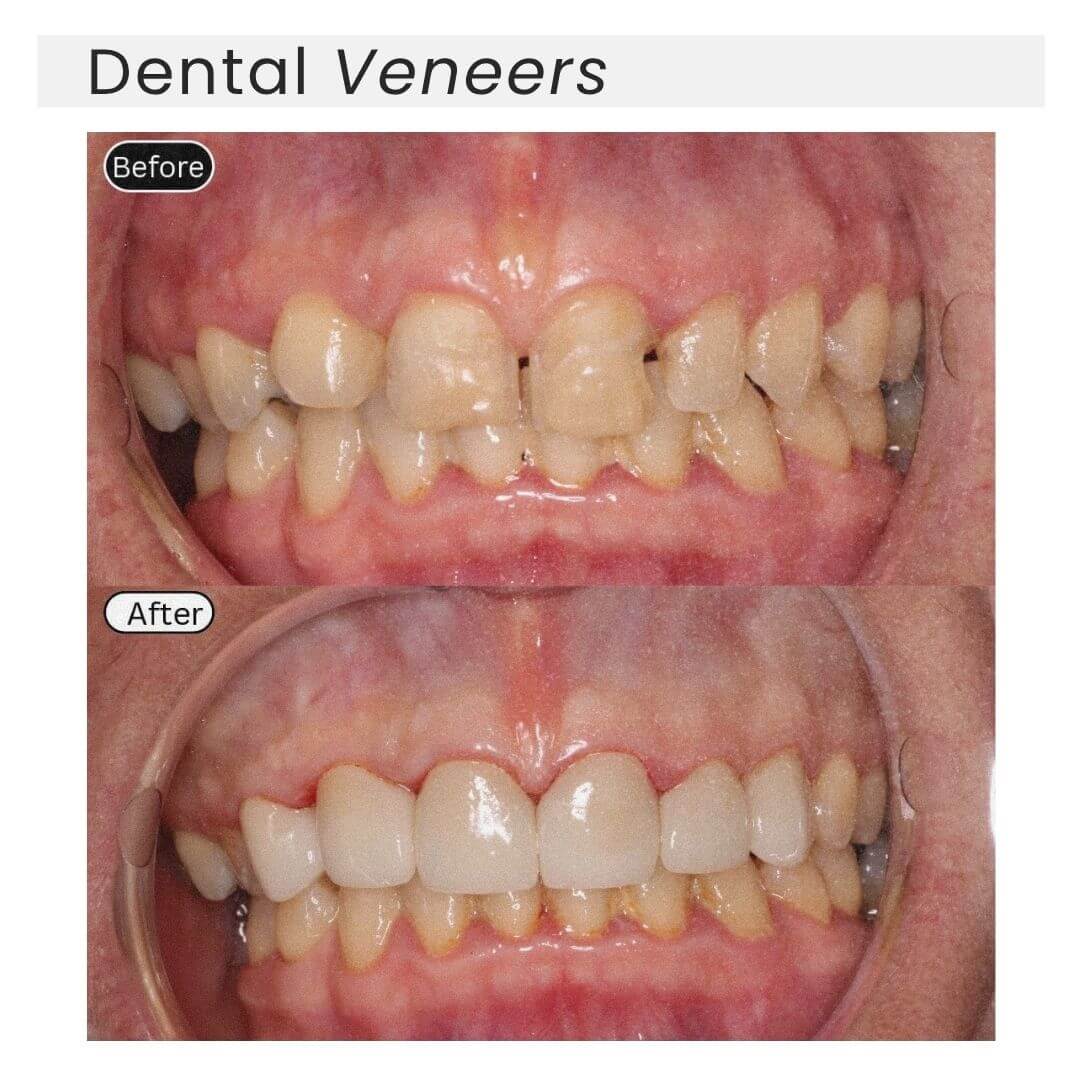 dental veneers