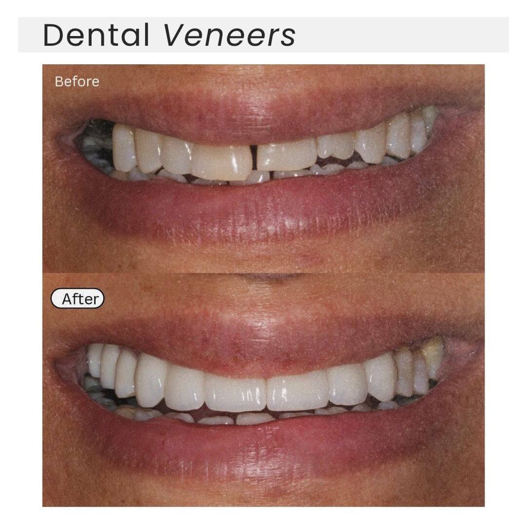 dental veneers