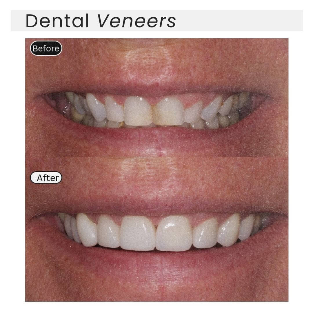 dental veneers