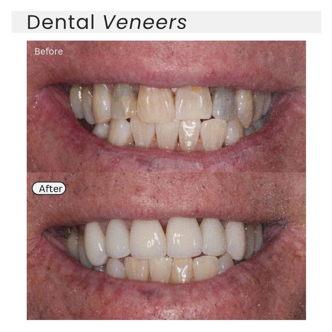 dental veneers