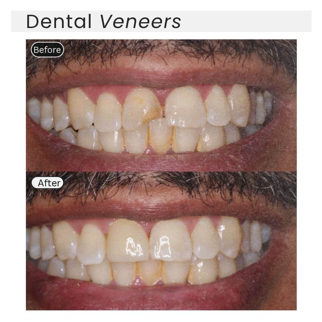 dental veneers