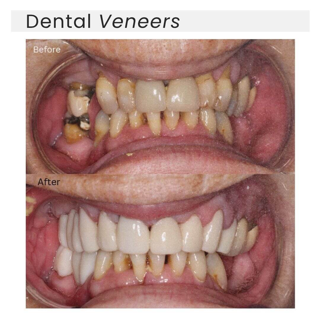 dental veneers