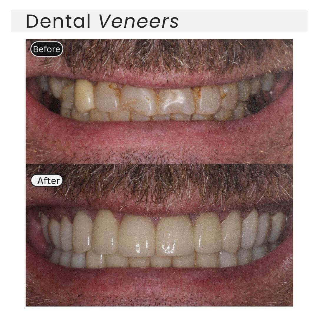 dental veneers