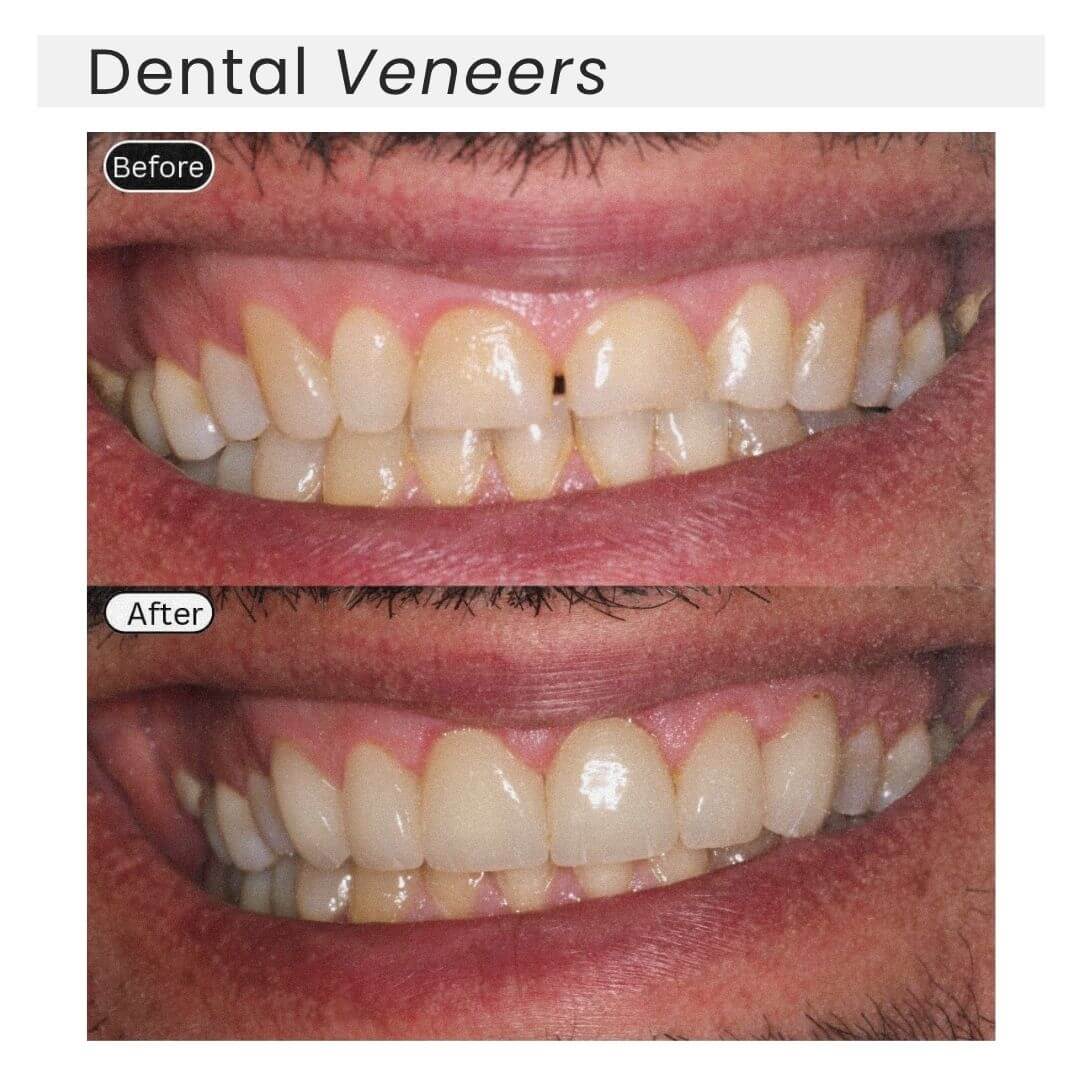 dental veneers