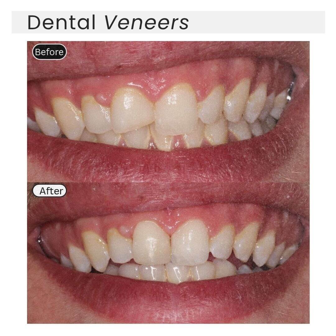 dental veneers