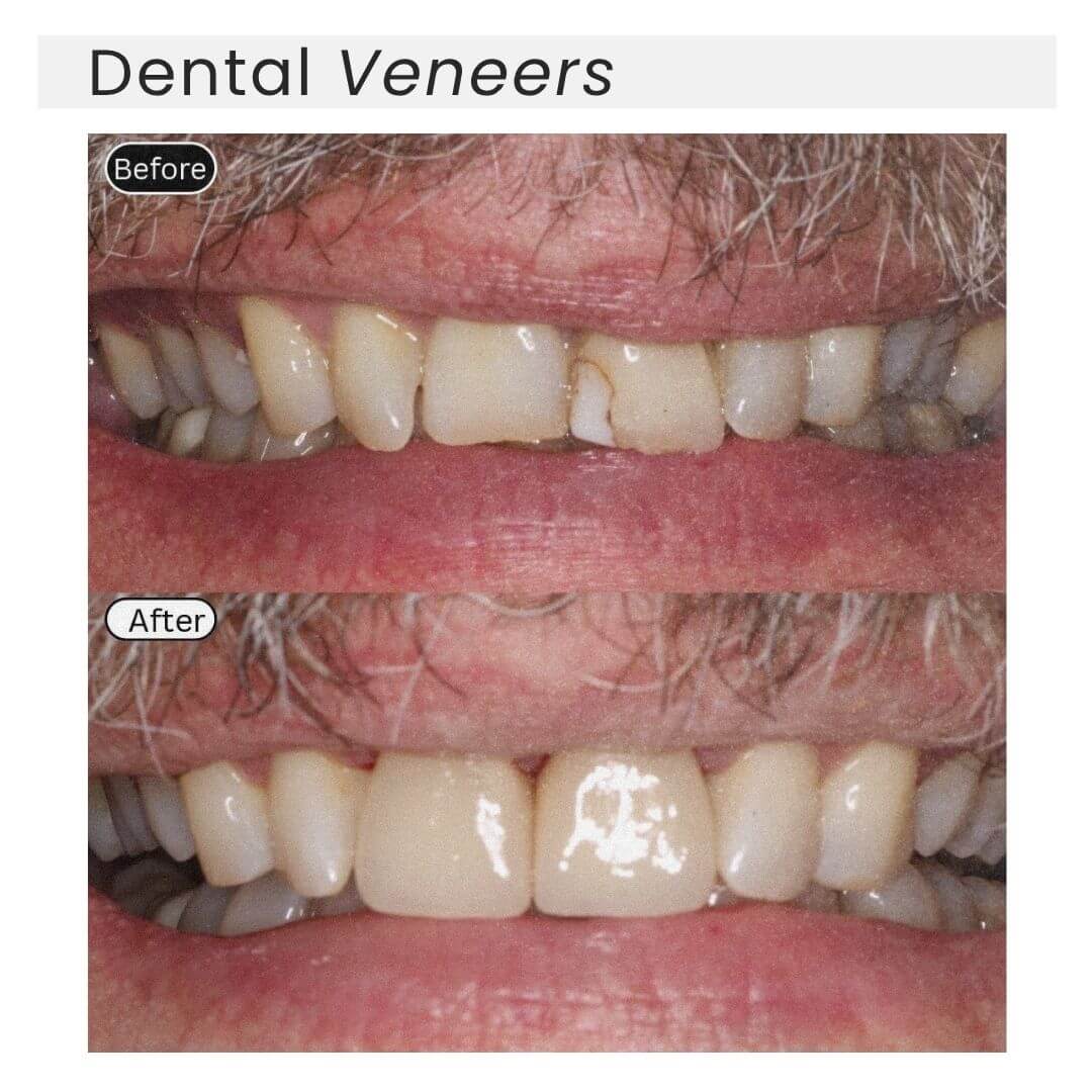 dental veneers