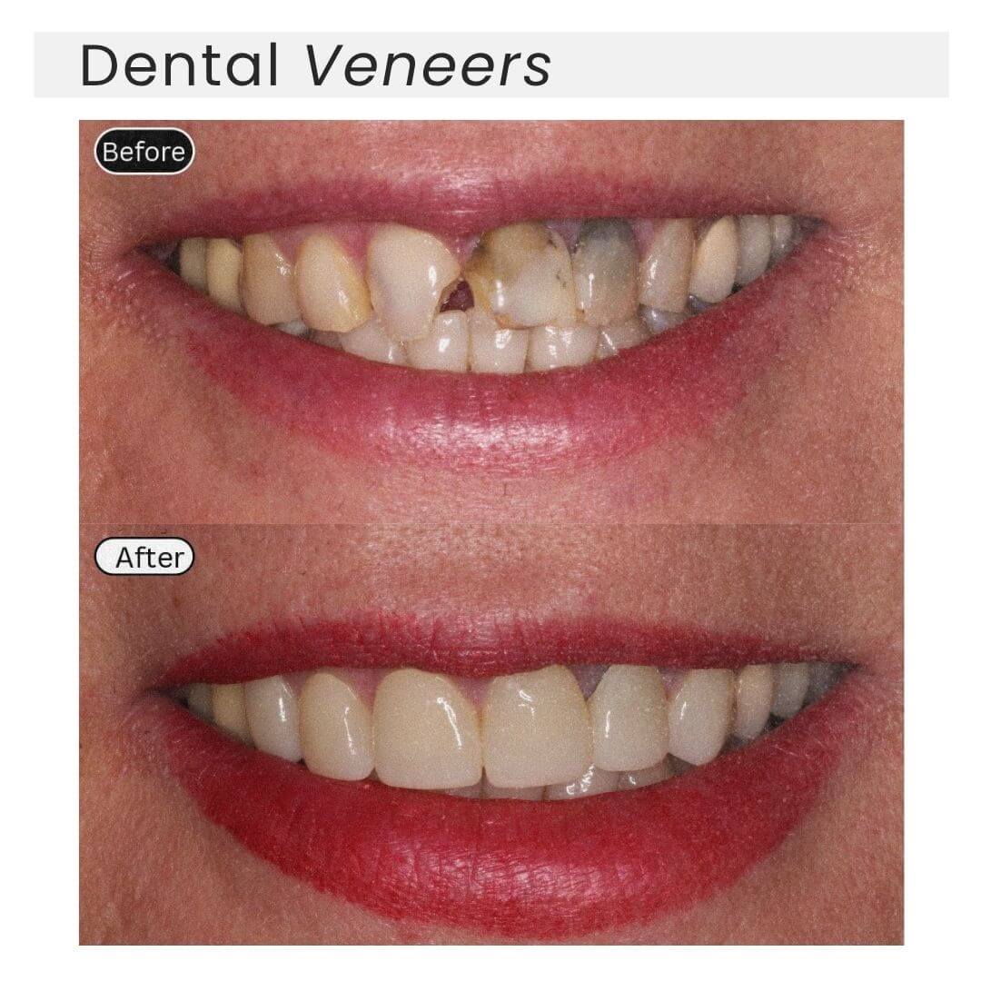 dental veneers