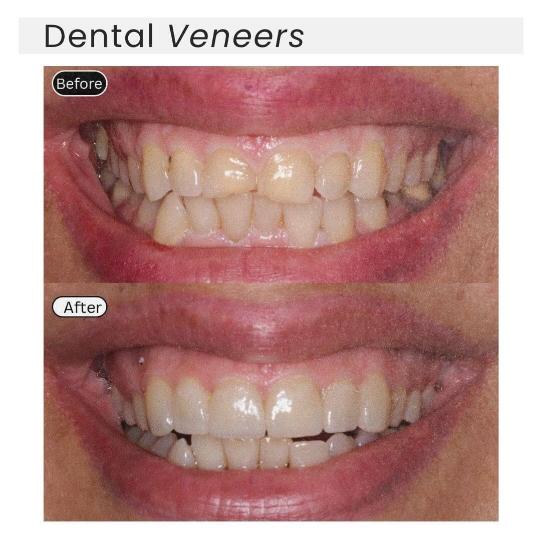 dental veneers