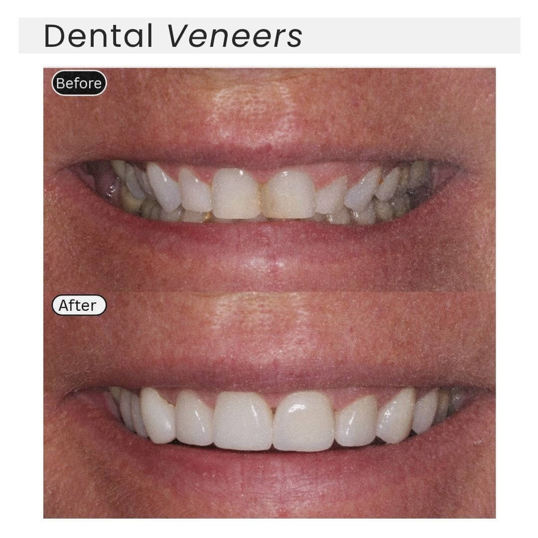 dental veneers