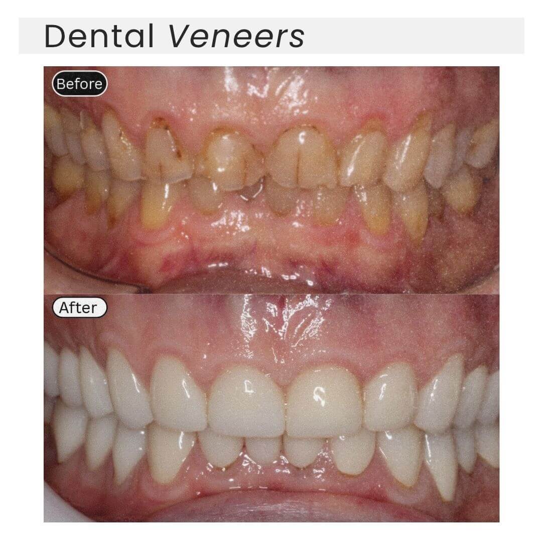 dental veneers