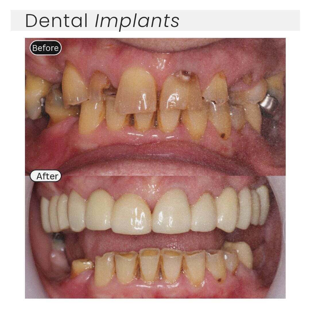 Dental implants