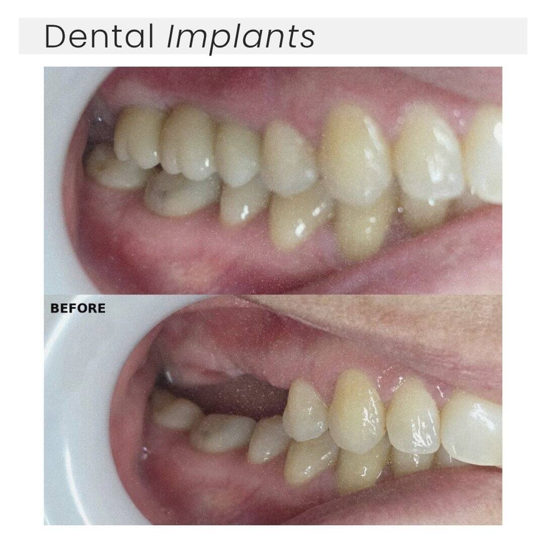 Dental implants