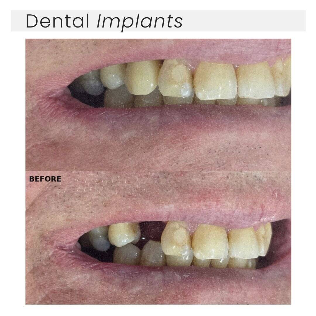 Dental implants