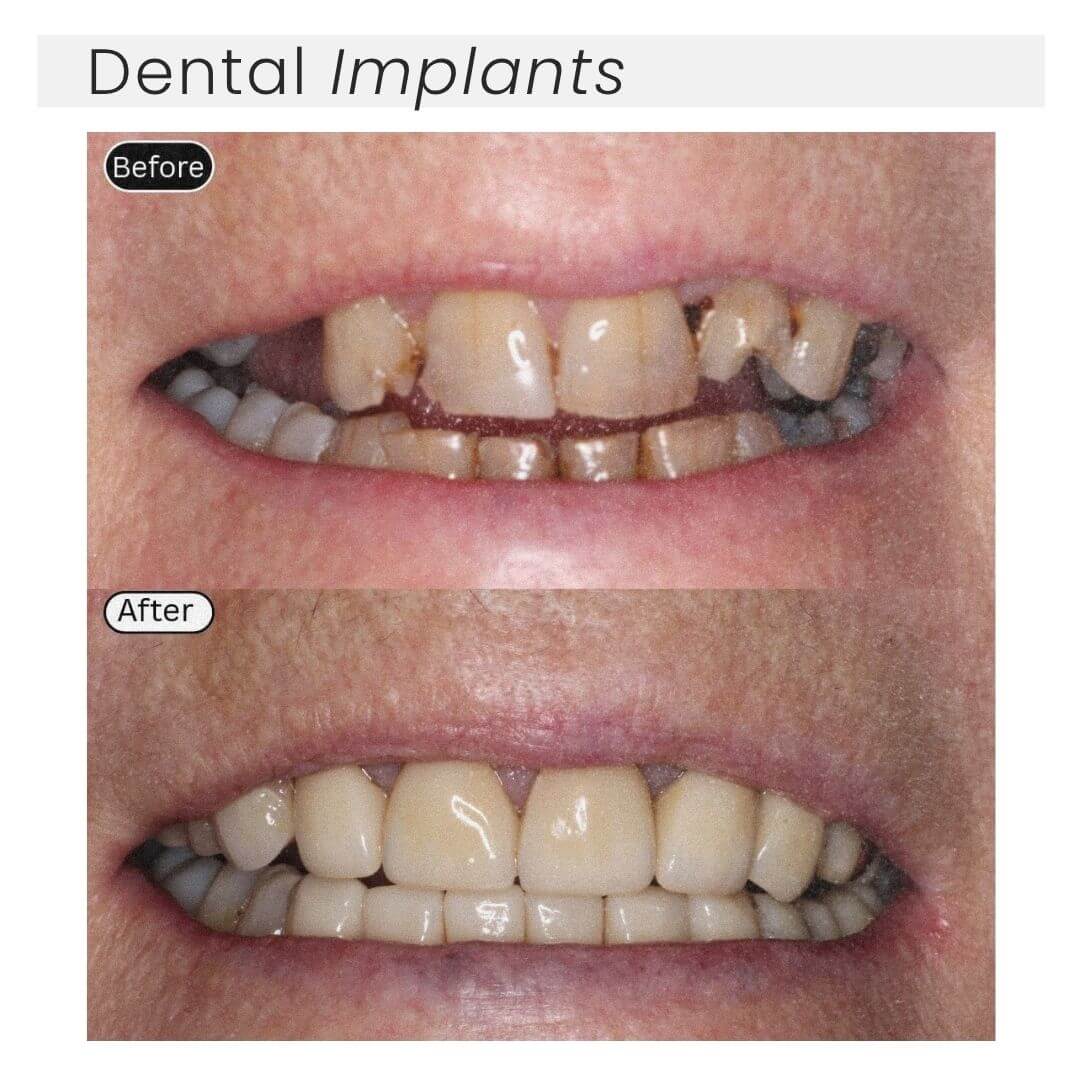 Dental implants