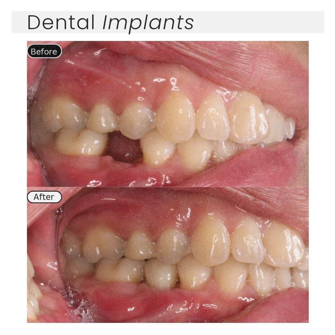 Dental implants