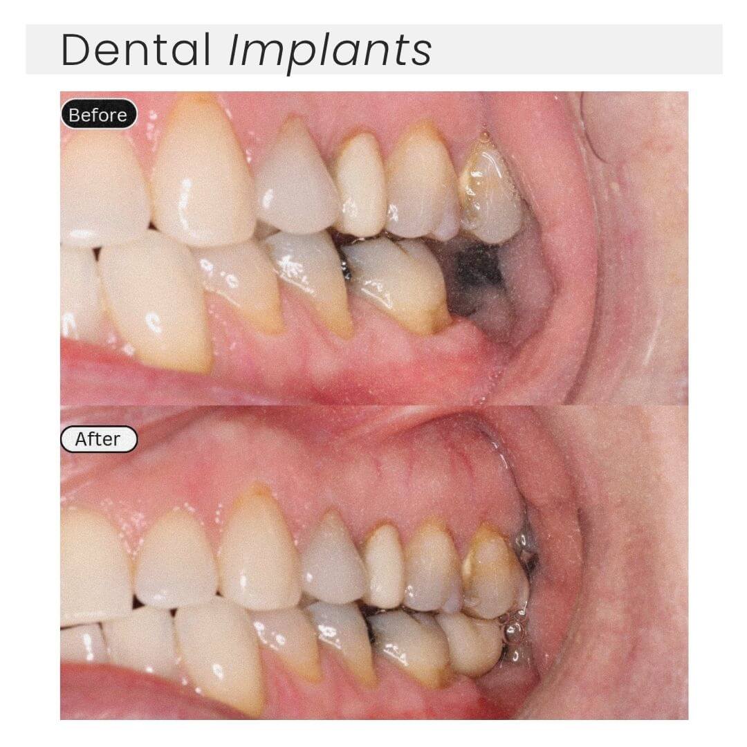 Dental implants