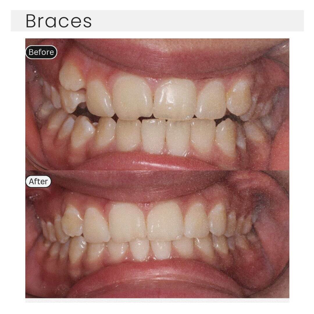 before and after