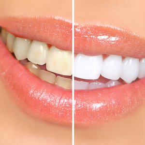 closeup of female mouth with teeth whitening before and after