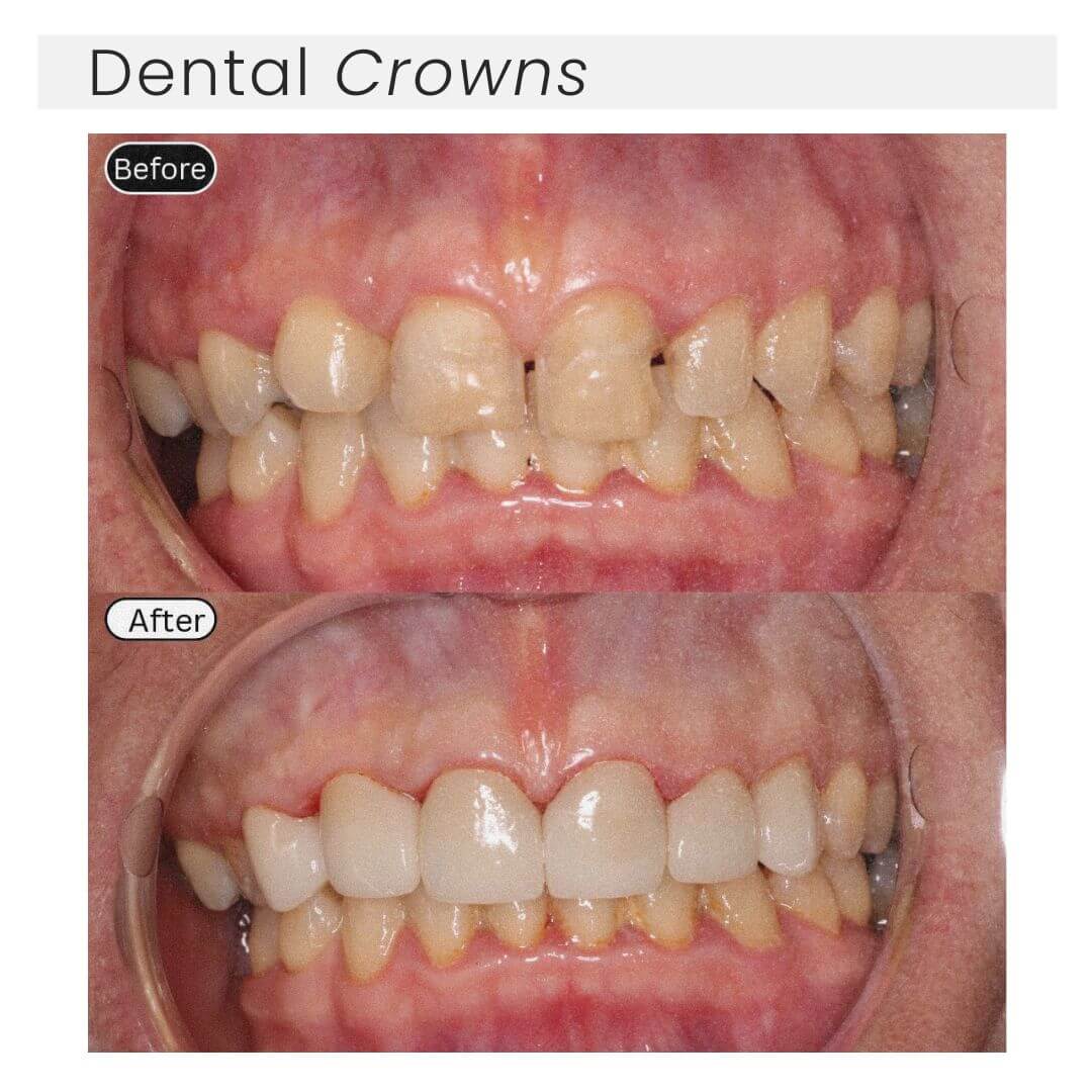 before and after