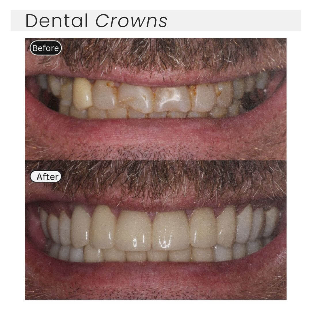 before and after