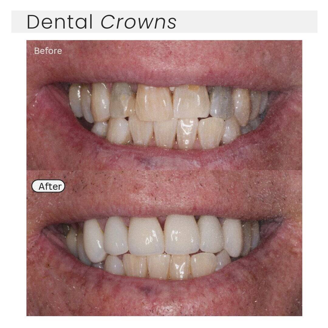 before and after