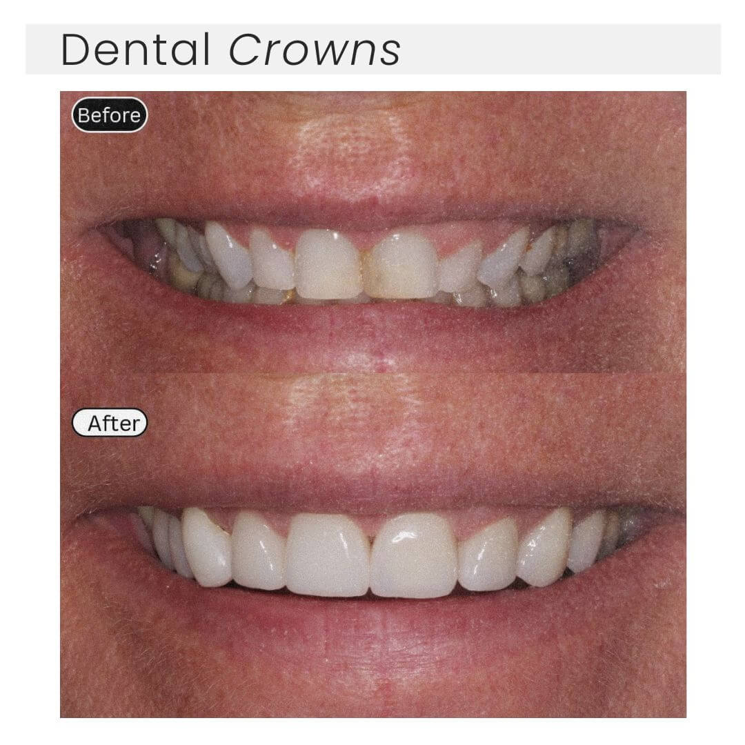 before and after