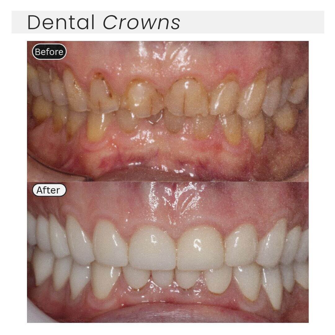 before and after