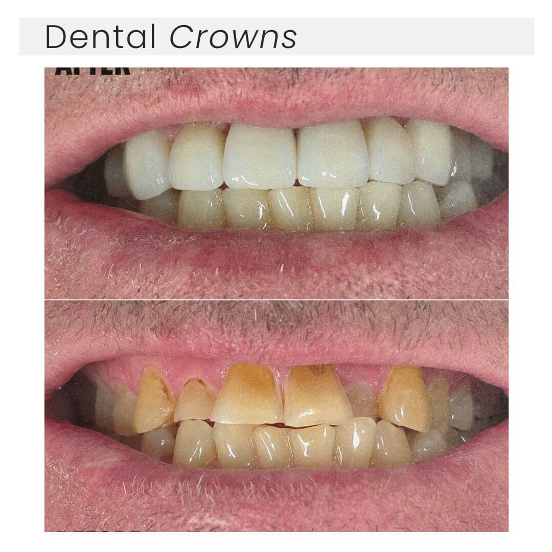 before and after